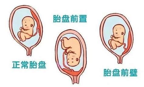 植入性胎盤是什麼 兼施 意思